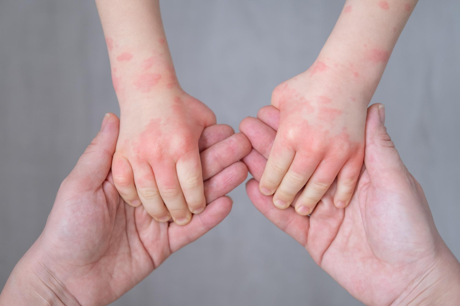 protect a child from a rash